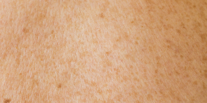 What Causes Pigmentation & How to Treat It Skinstore