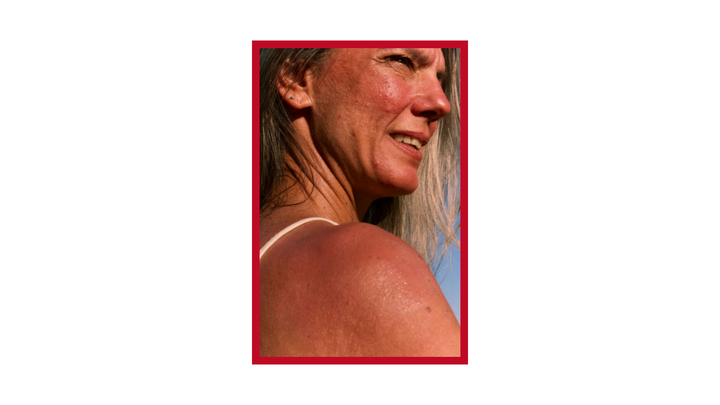 Soothe the Flare: Coping with a Sensitive skin
