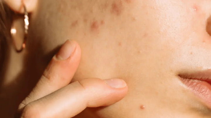 Teen Acne: Causes and Product Solutions Skinstore