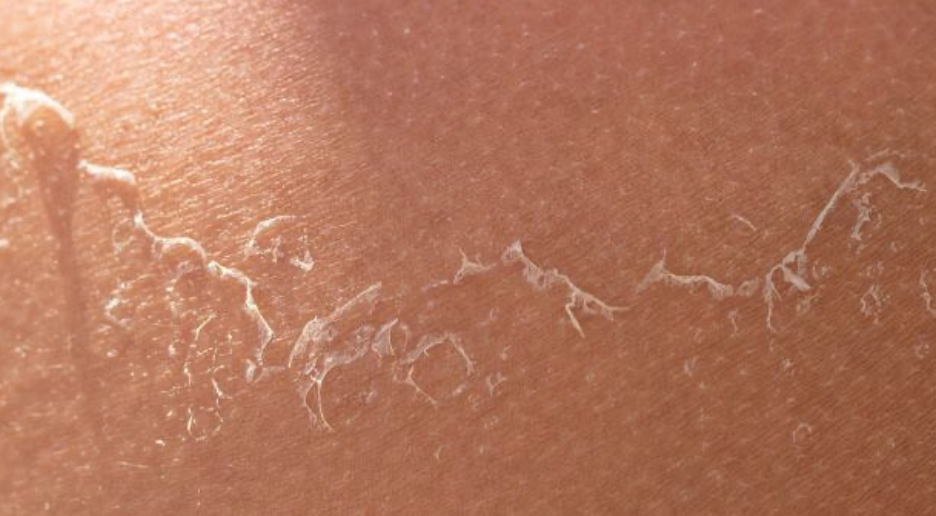 Skin-cancer-sunburn-and-sunscreen Skinstore