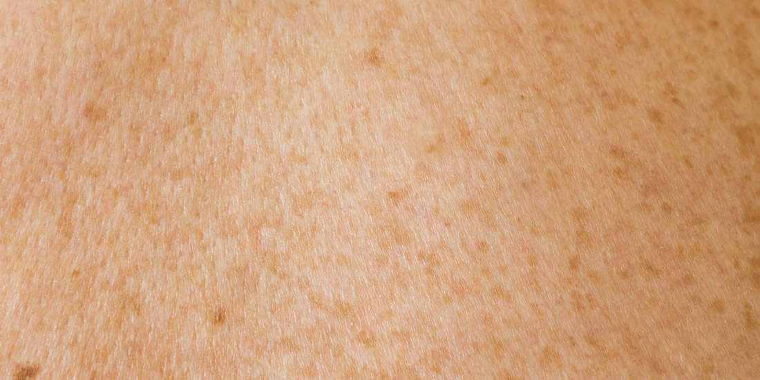 What Causes Pigmentation & How to Treat It Skinstore