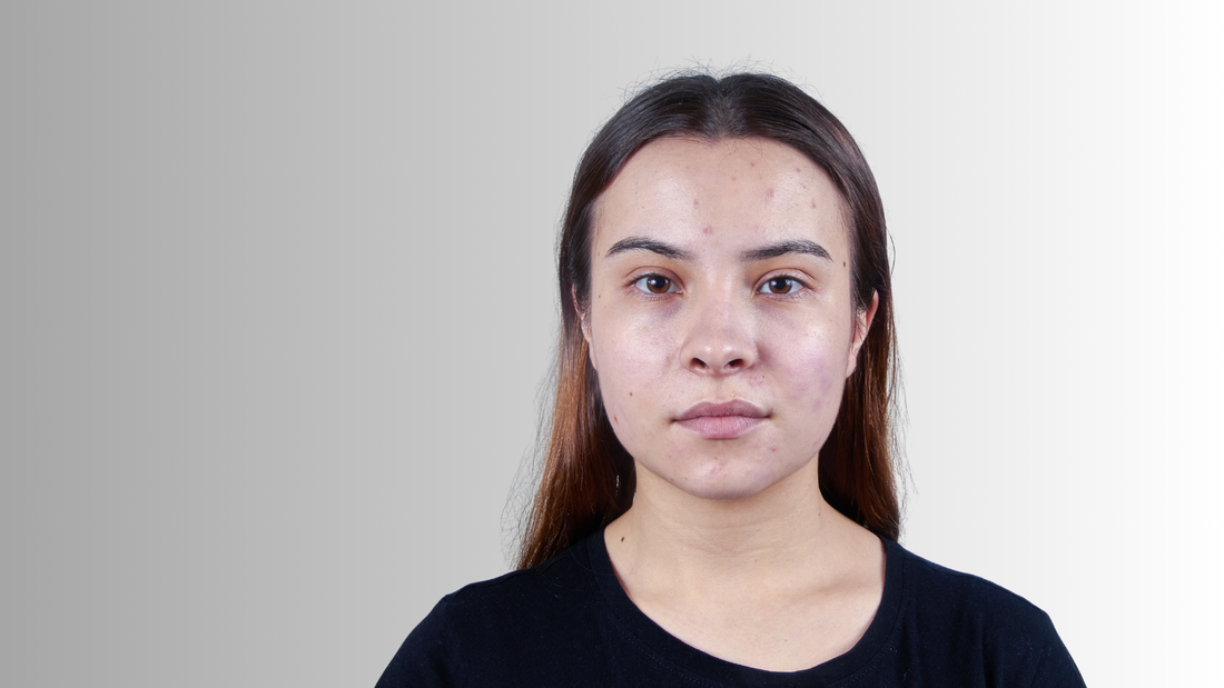 Female with Acne